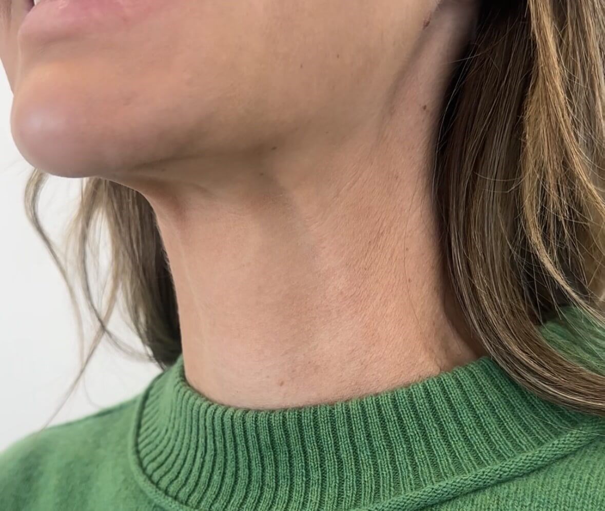 Platysmal Bands Botox After