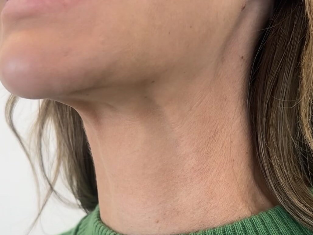 Platysmal Bands Botox After