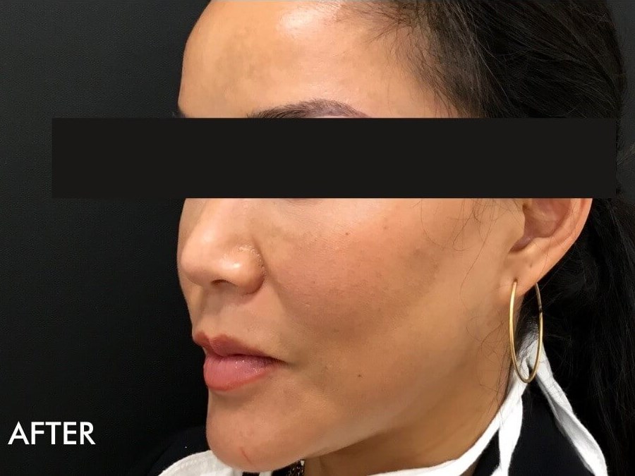 Cheek Filler before and After After
