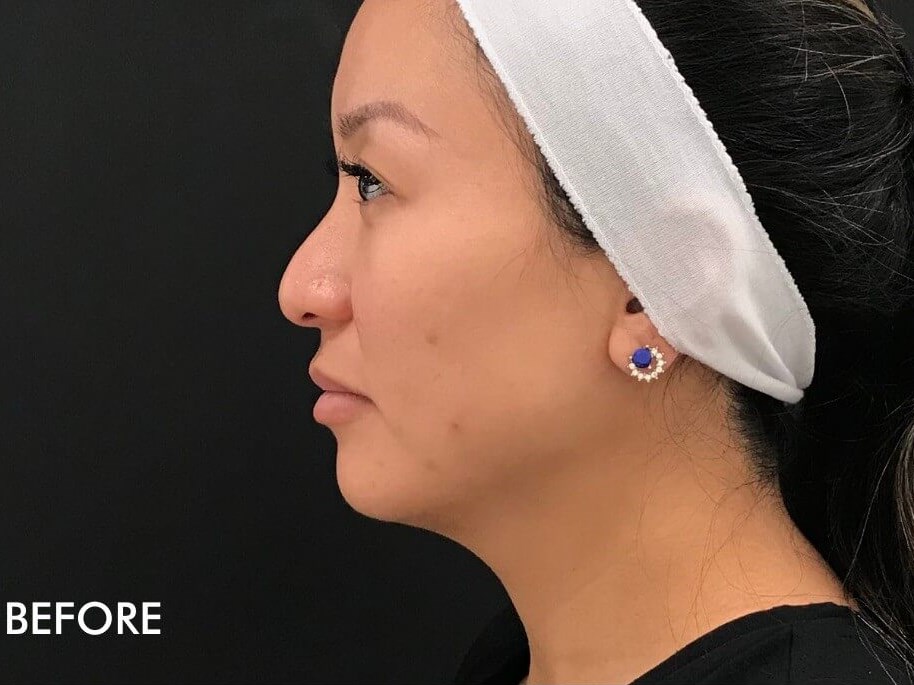 Jawline Filler Photos Before