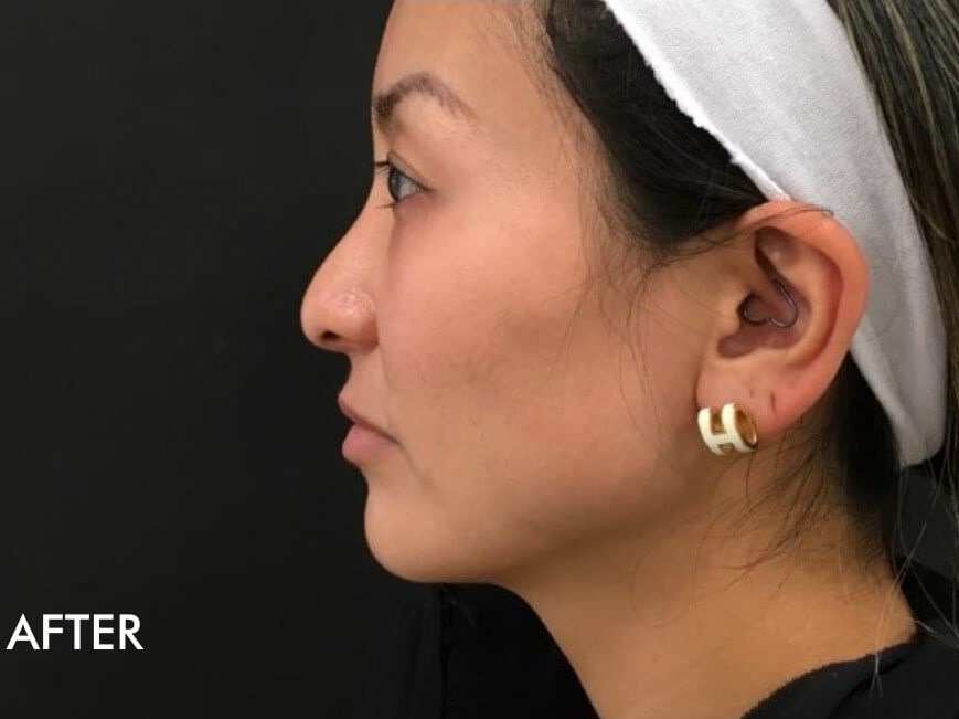 Jawline Filler Photos After