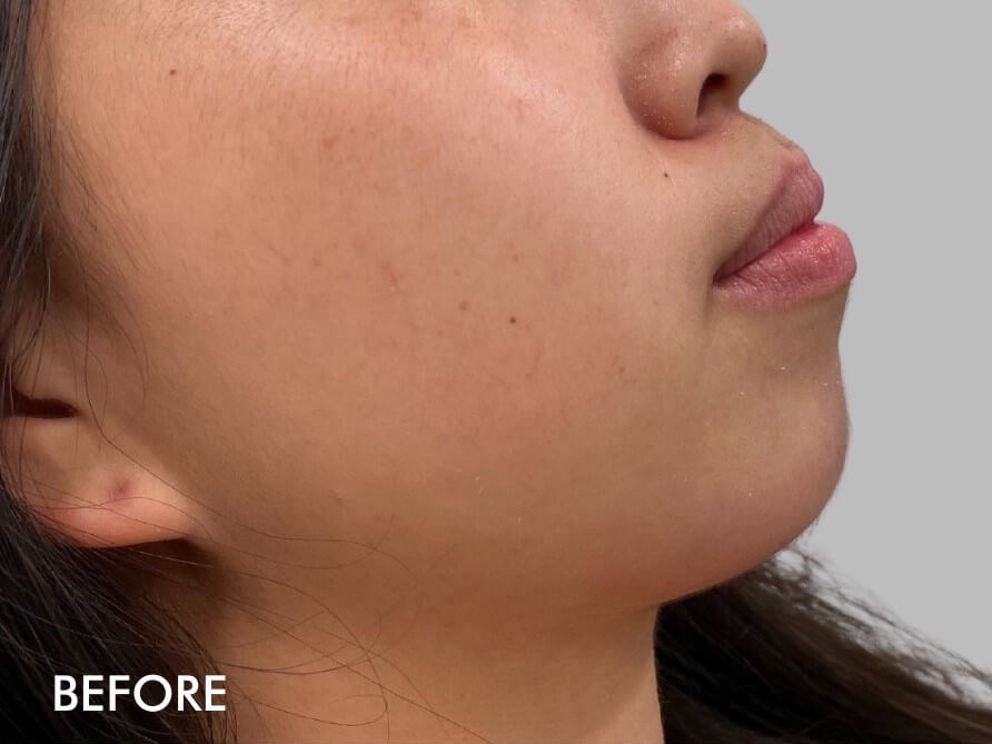 Chin Filler Before and After Before