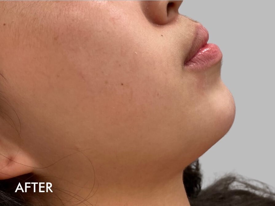 Chin Filler Before and After After
