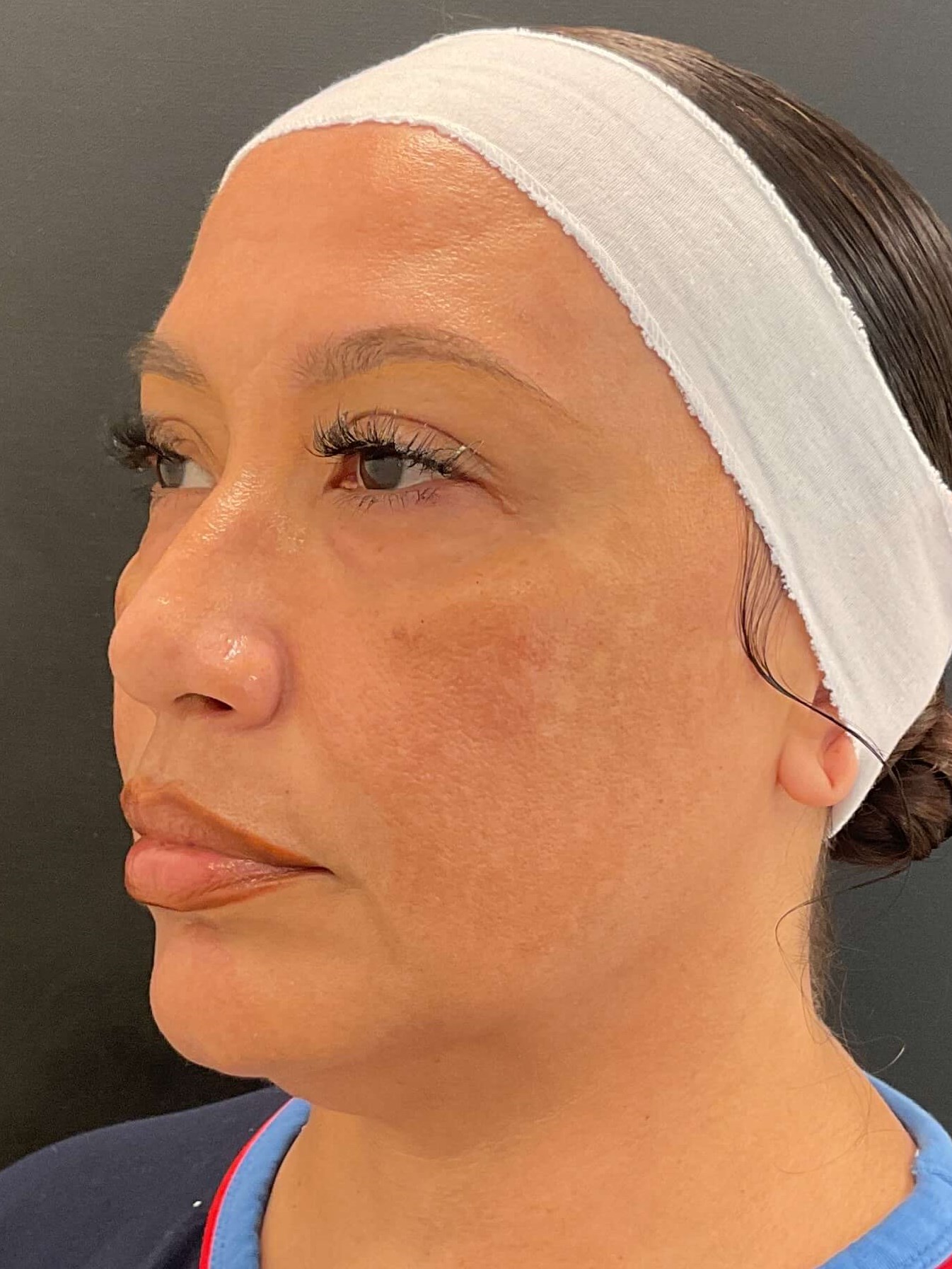 Before and After Photos Before