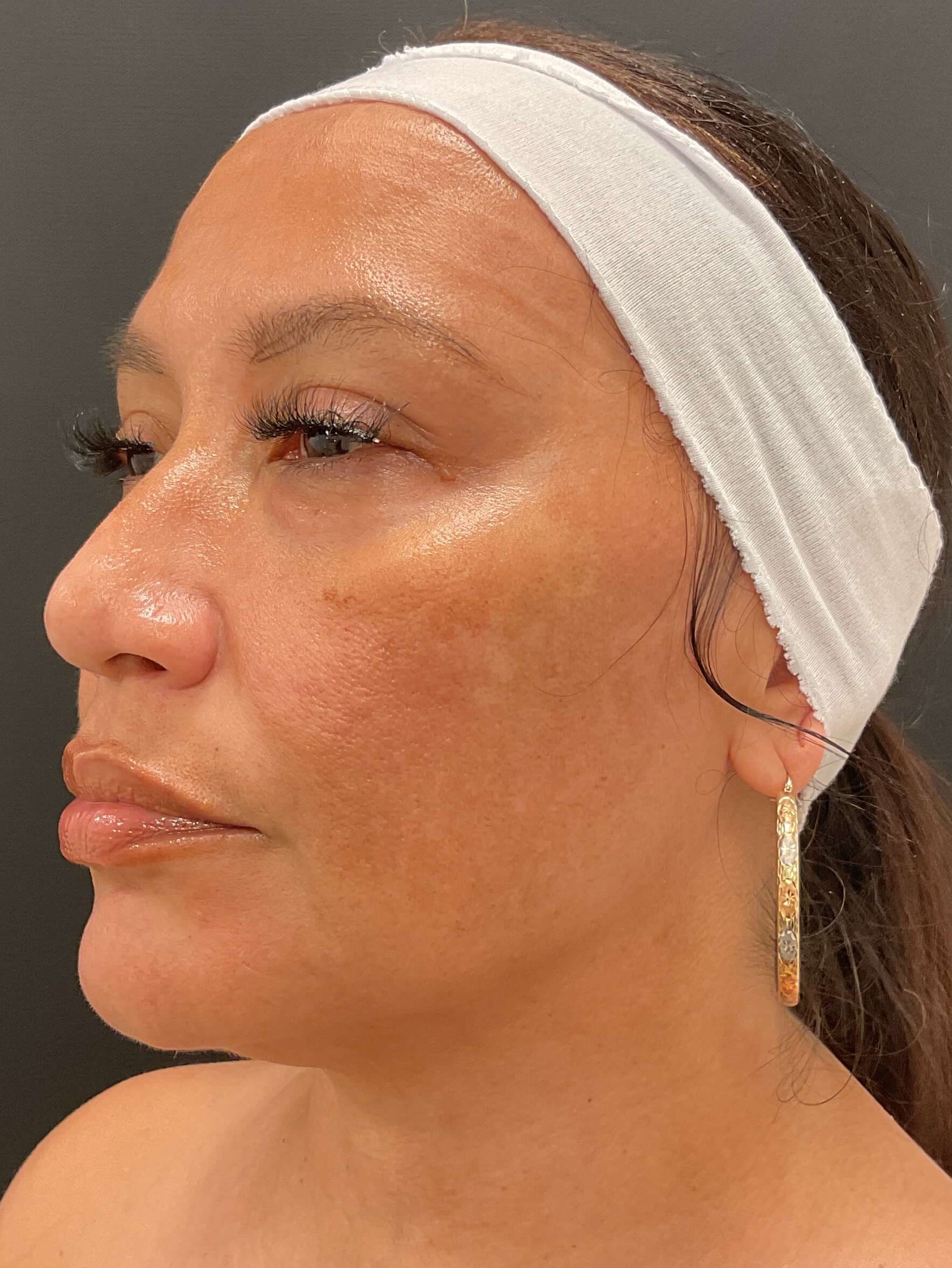 Before and After Photos After