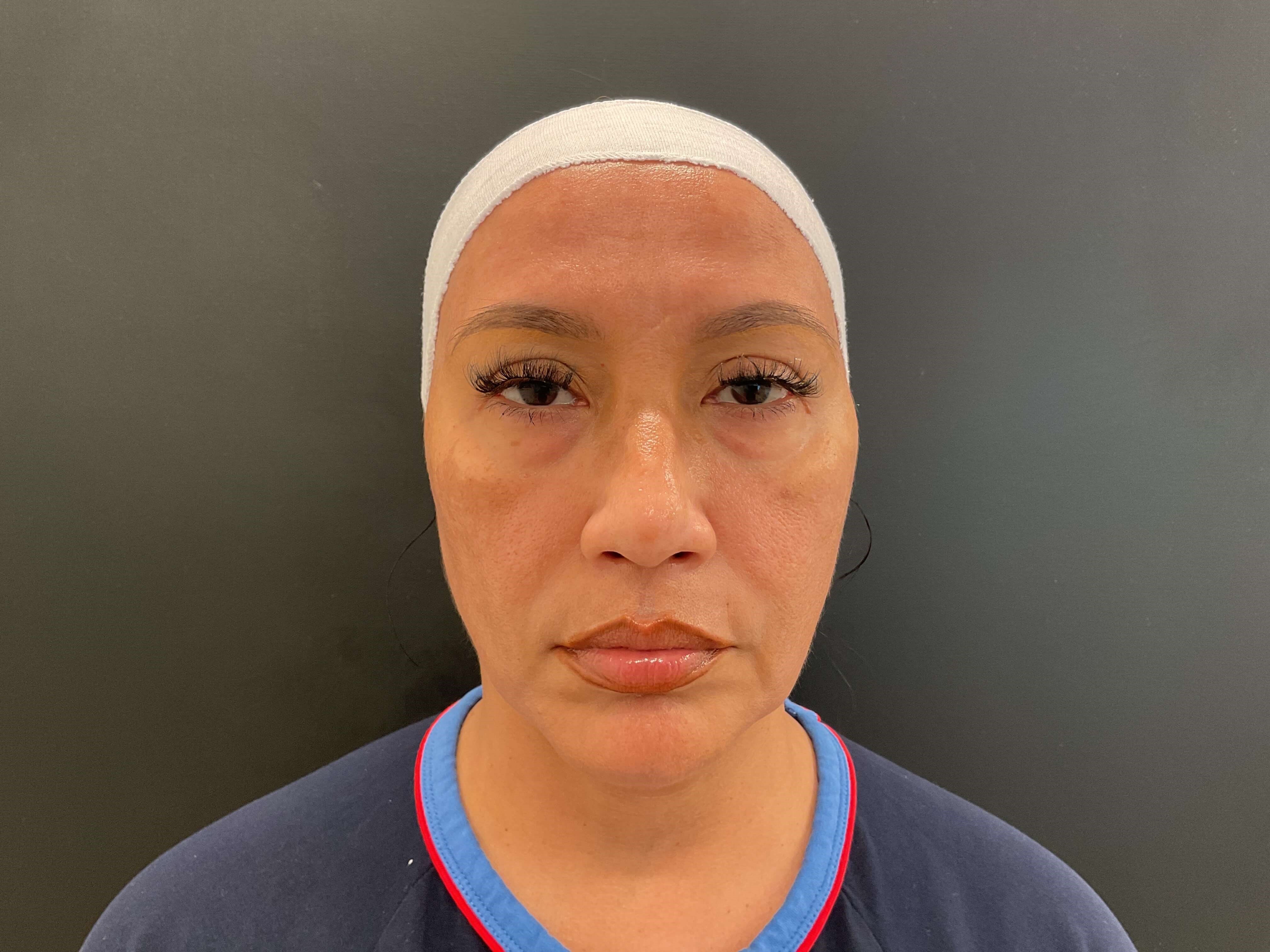 Before and After Photos Before