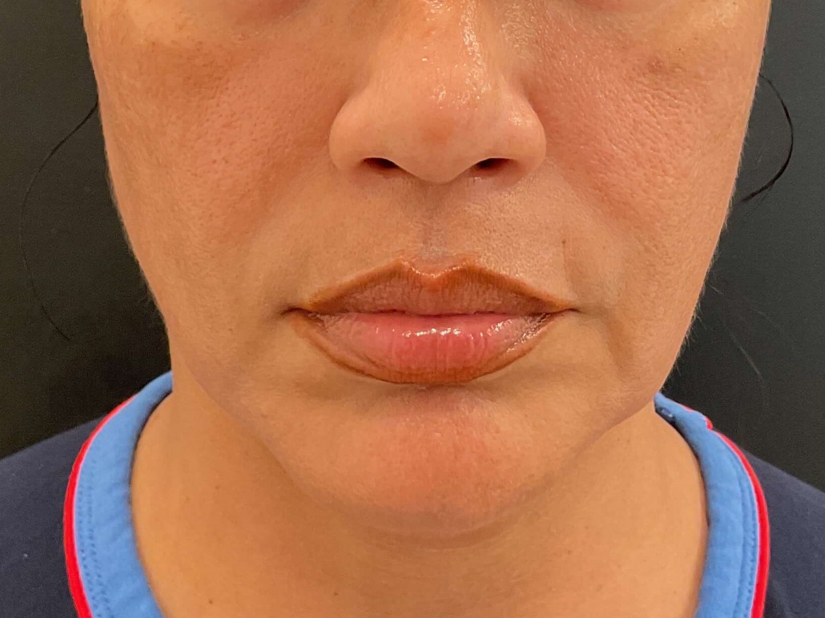 Before and After Photos Before