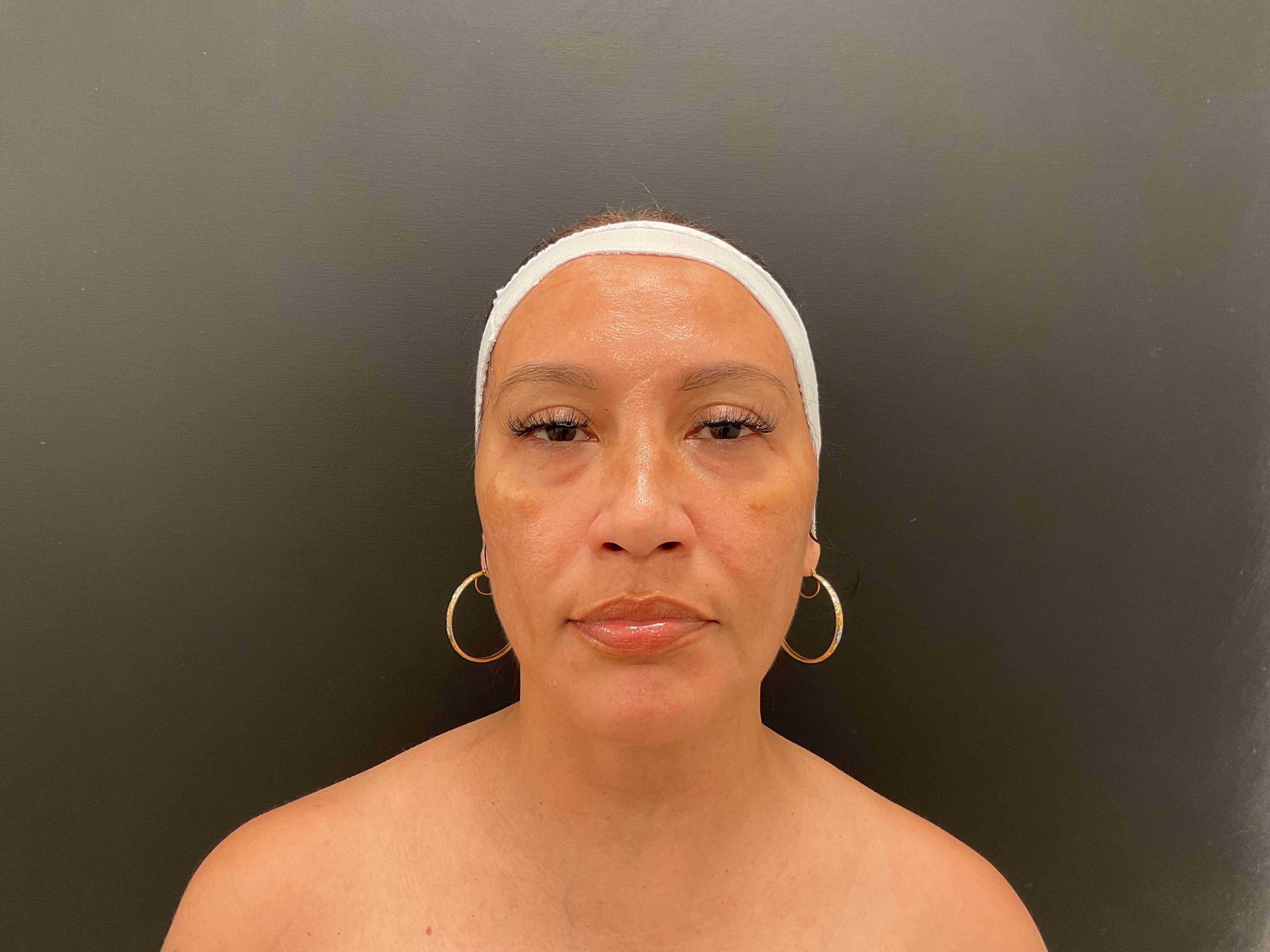 Before and After Photos After