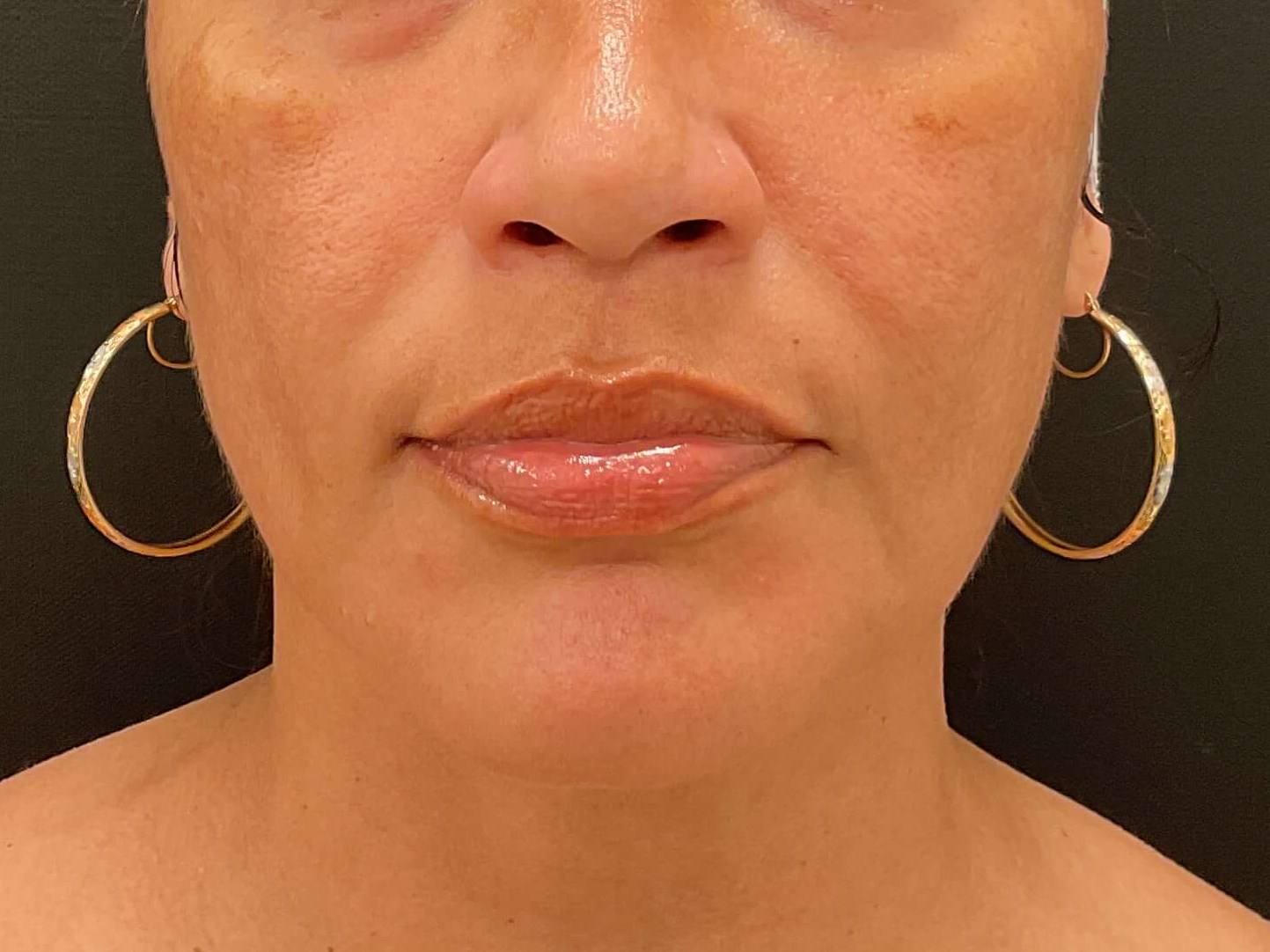 Before and After Photos After