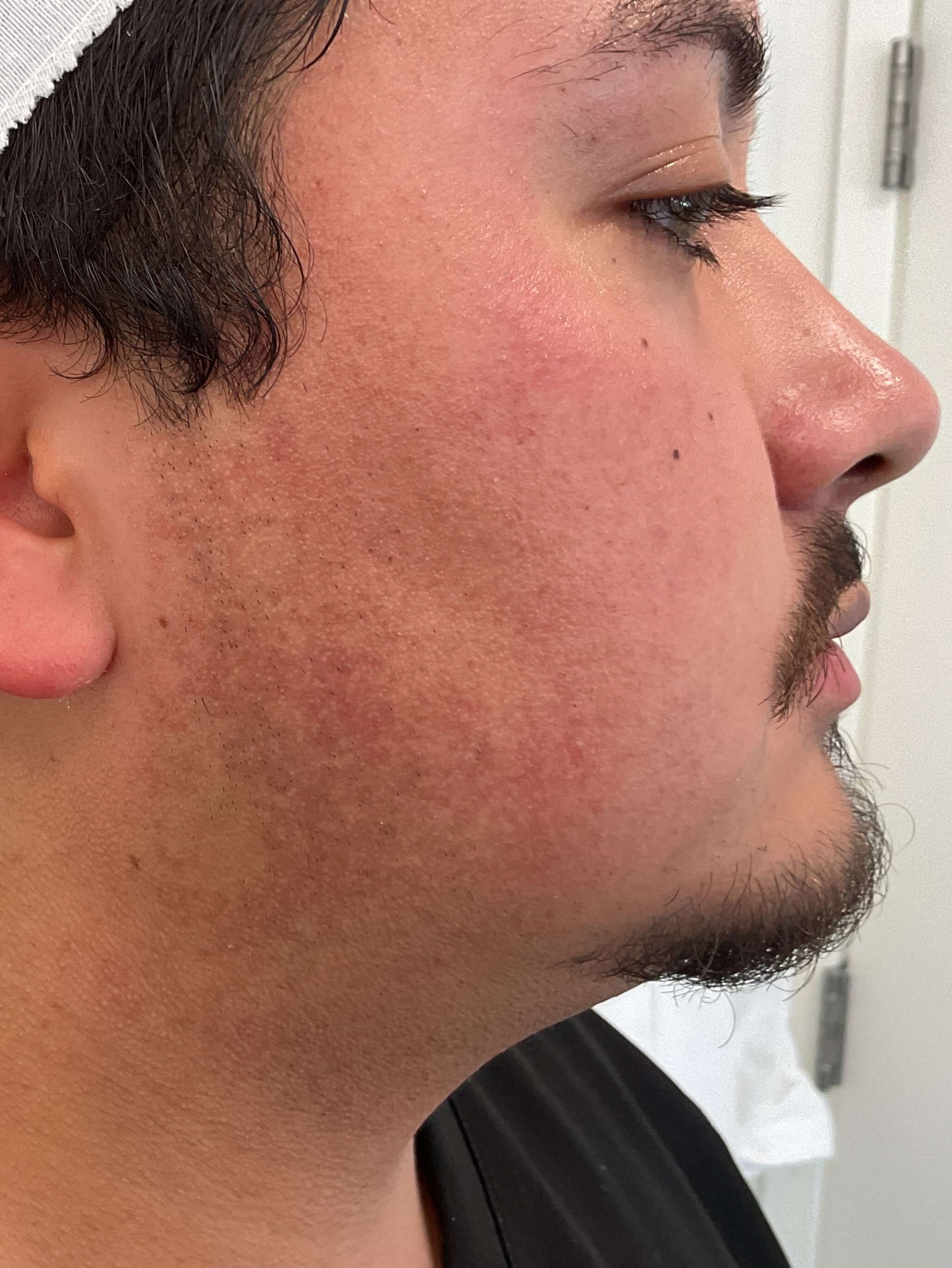 Fraxel Laser Resurfacing Before