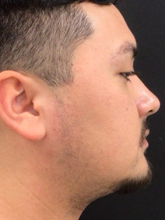 Fraxel Laser Resurfacing After