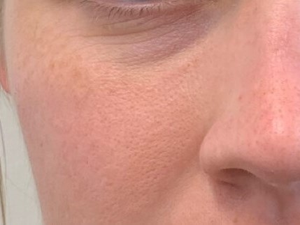 Tear Trough Filler Before