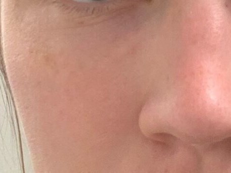 Tear Trough Filler After