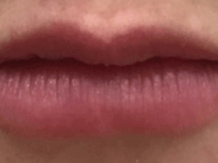 Lip Filler Before