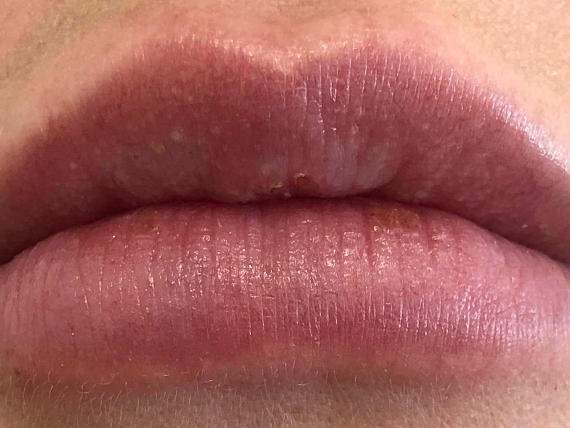 Lip Filler After