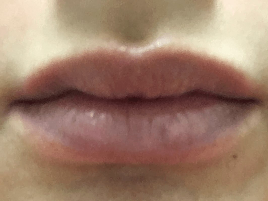 Lip Filler Before
