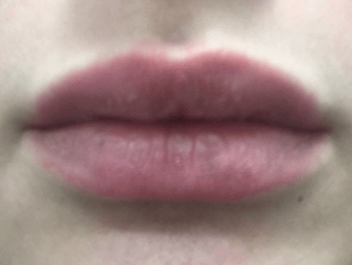 Lip Filler After