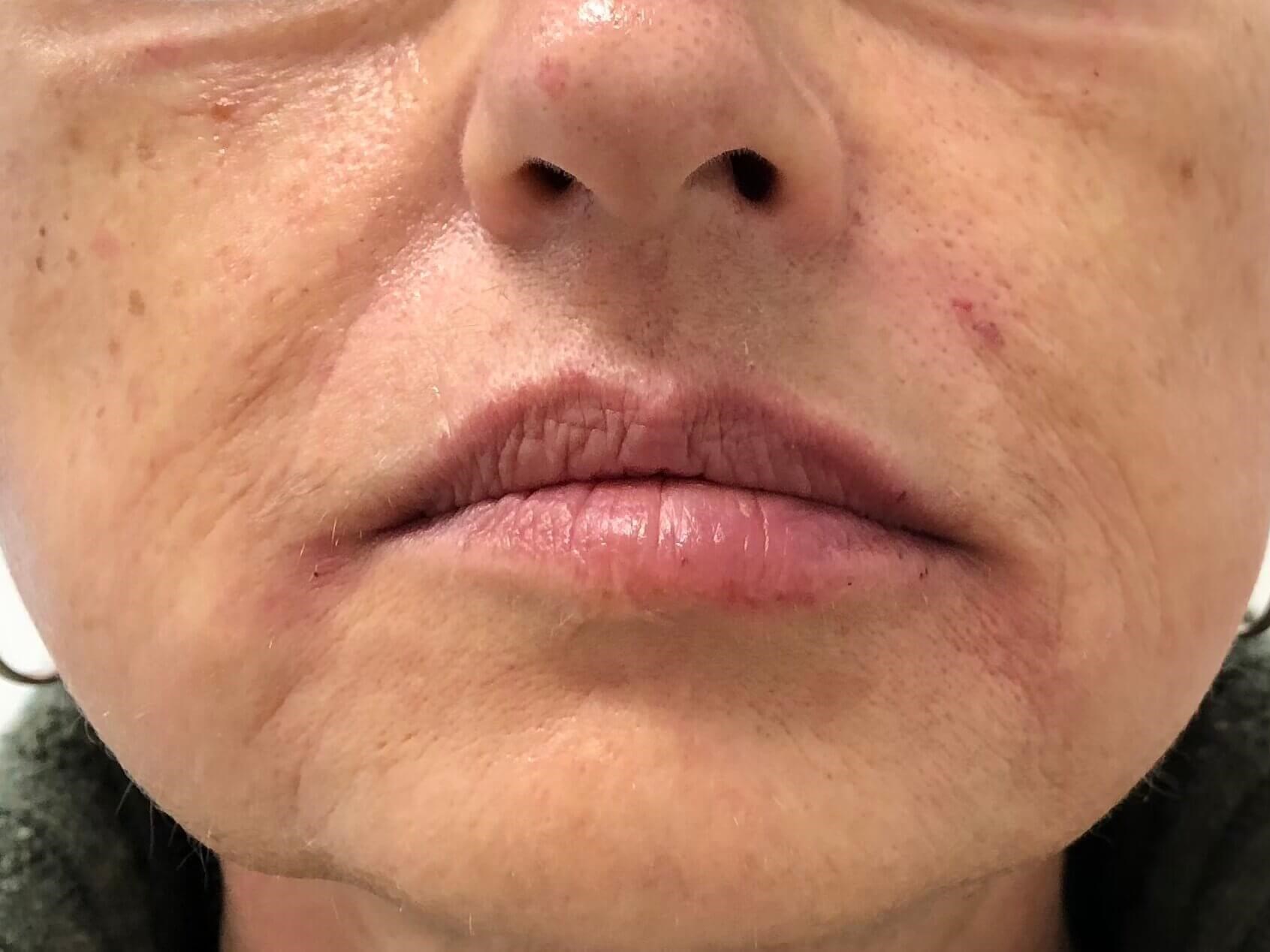 Lower Face Filler After