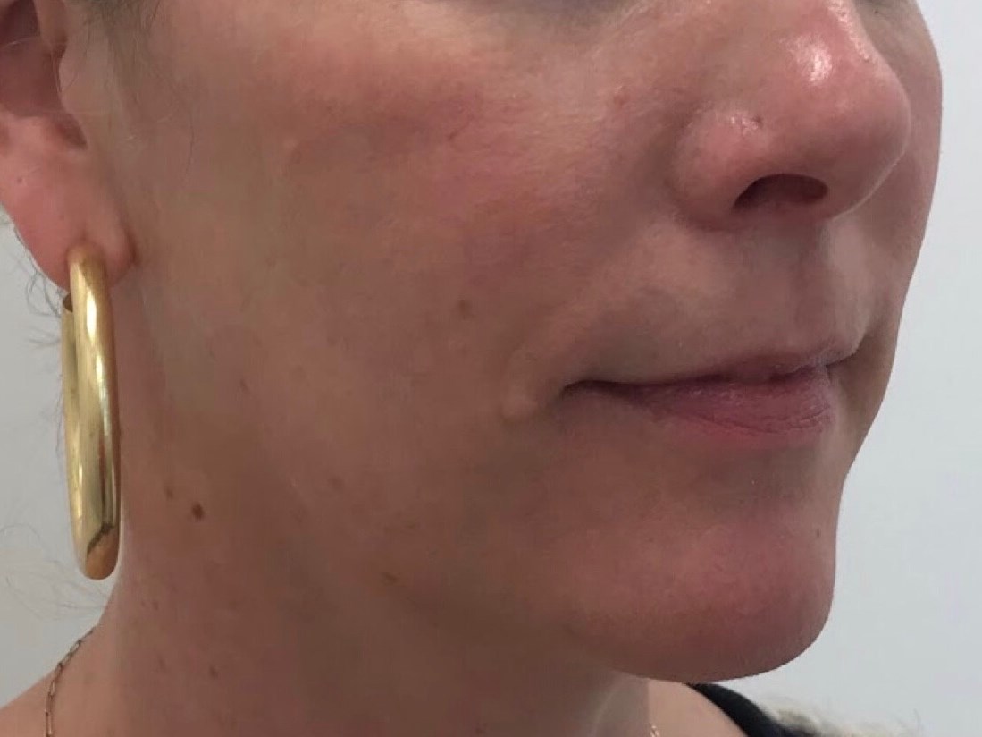Lower Cheek Fat Reduction Before