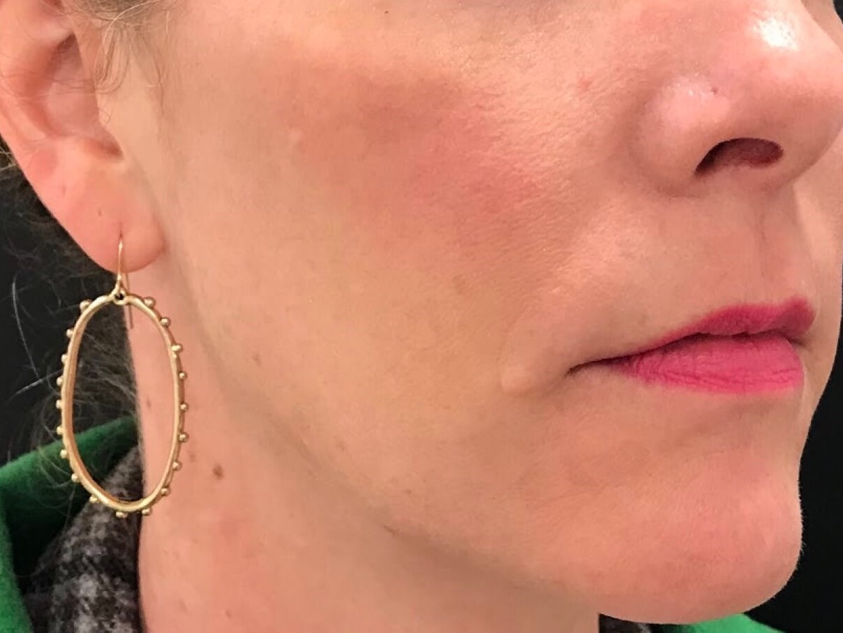 Lower Cheek Fat Reduction After