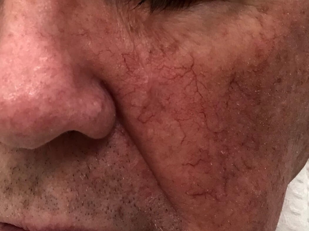 Mohs Scar Example After