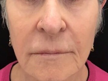 Smile Lines Treatment After