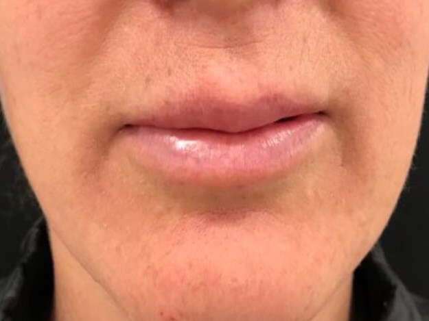 Enhancing lip volume Before