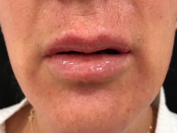 Enhancing lip volume After