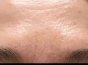 Eleven Line Correction After