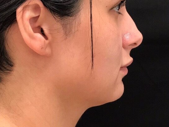 Kybella Treatment Before
