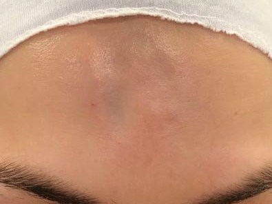 Skin Atrophy Treatment Before