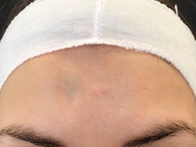 Skin Atrophy Treatment After