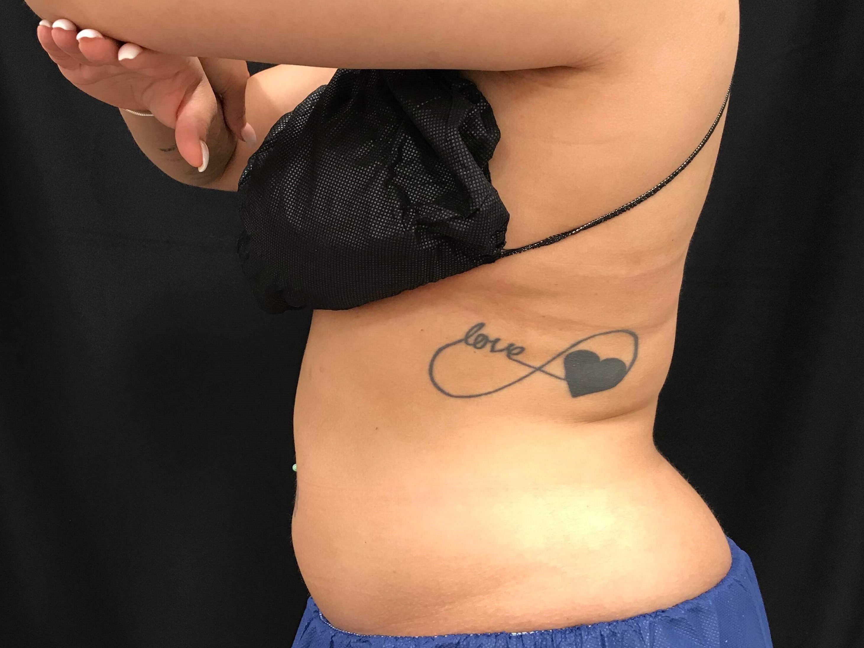 Abdomen & Flank Sculpting Before