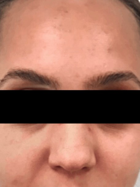 Anti-Aging Laser Treatment Before