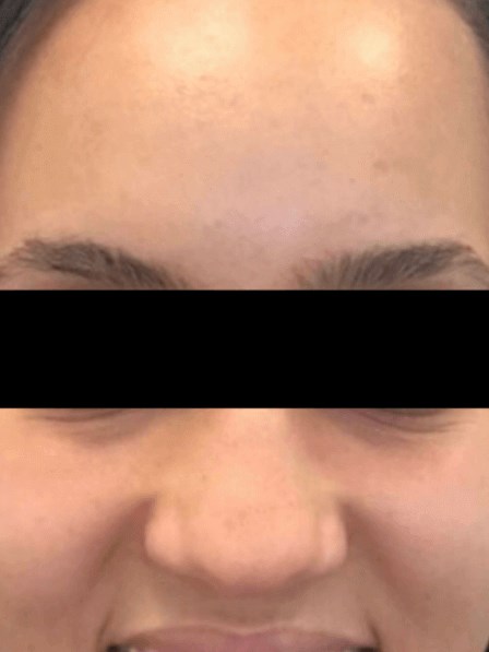 Anti-Aging Laser Treatment After