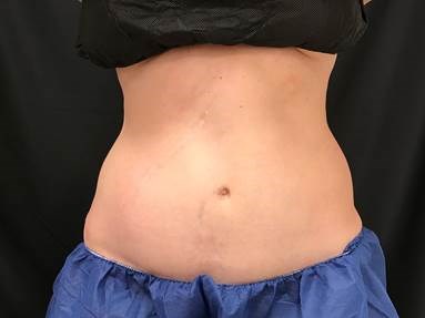 Abdomen Sculpting Before