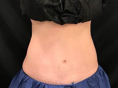 Abdomen Sculpting After
