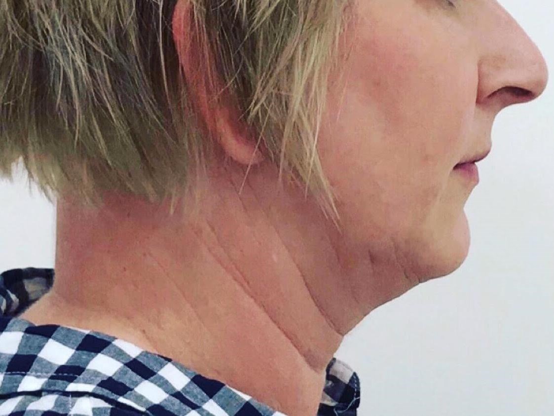 Submental Fat Reduction Before