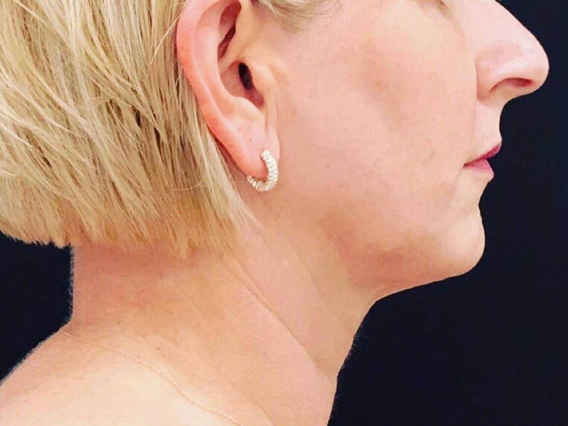 Submental Fat Reduction After