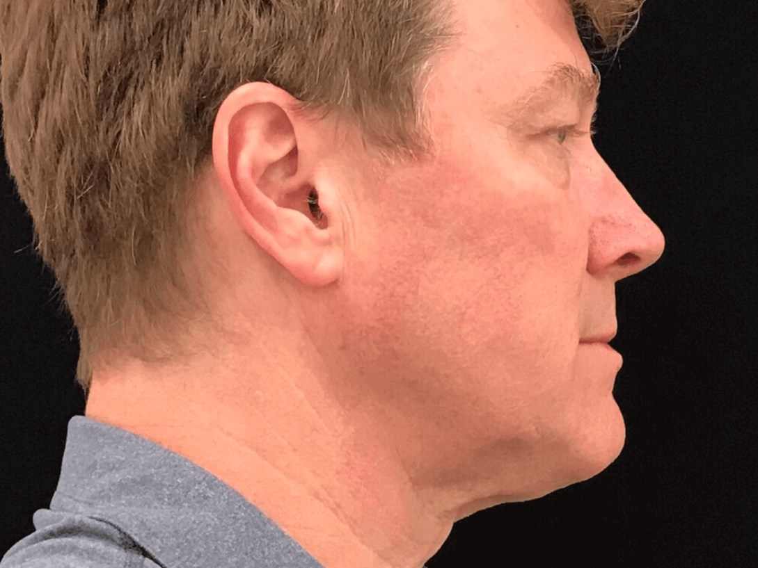Chin Sculpting After