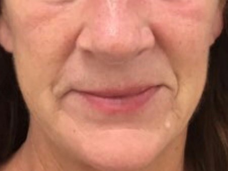 Smile Line Filler Before