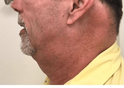 Submental Sculpting & Kybella Before