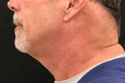Submental Sculpting & Kybella After