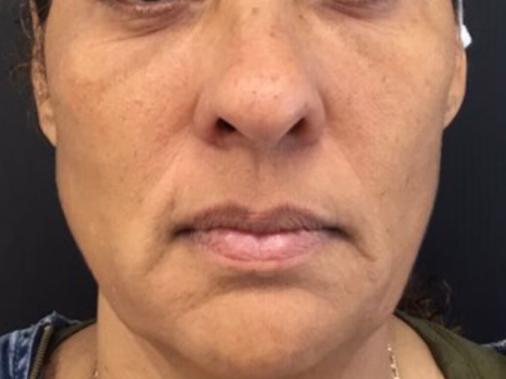 Mid-face Filler After