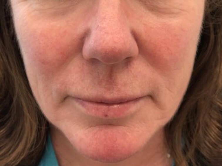 Facial Vein Reduction Before