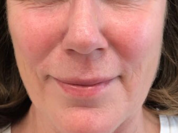 Facial Vein Reduction After