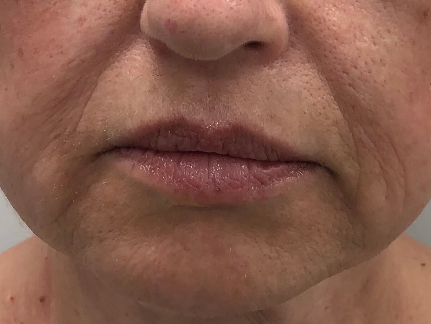 Lower Face Filler Before