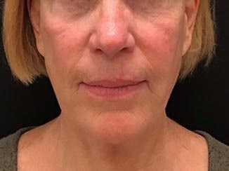 Lower Face Filler Before