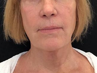 Lower Face Filler After