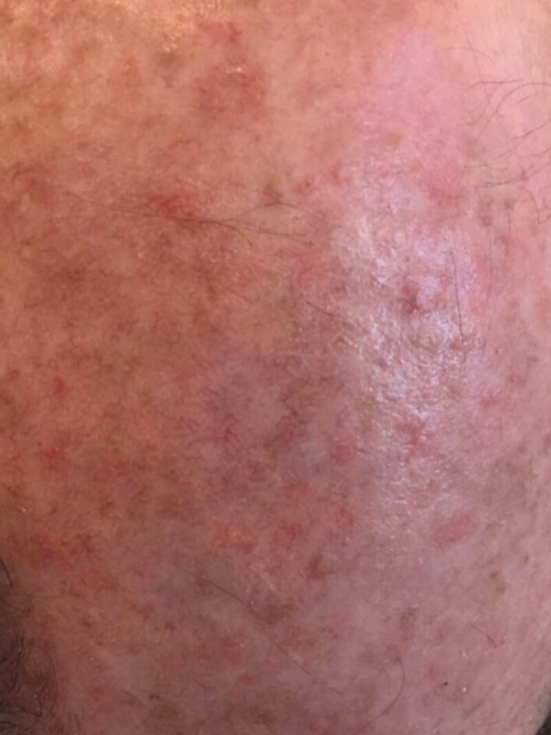Anti-Aging Laser Treatment Before